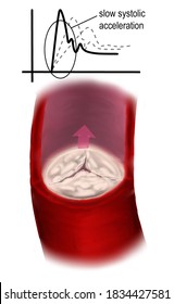 Aortic Valve Stenosis And Flow Waveform 