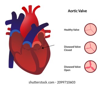 Aortic valve stenosis illustration. Healthy and disease aortica valve