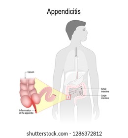 Appendicitis Inflammation Appendix Large Intestine Appendix Stock ...