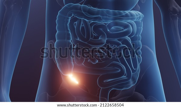 Appendix in human body, Appendicitis concept 3d illustration