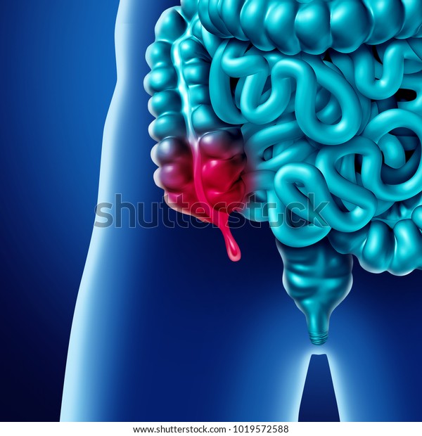 Appendix\
pain and appendicitis inflammation disease concept as a close up of\
human intestine anatomy as a 3D\
illustration.