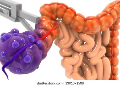 Appendix Surgery Concept. 3d Render