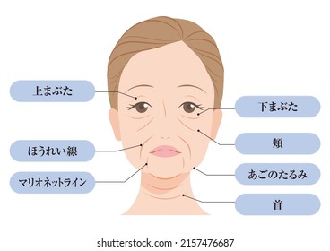 Areas Of Sagging In A Woman's Face (left: 