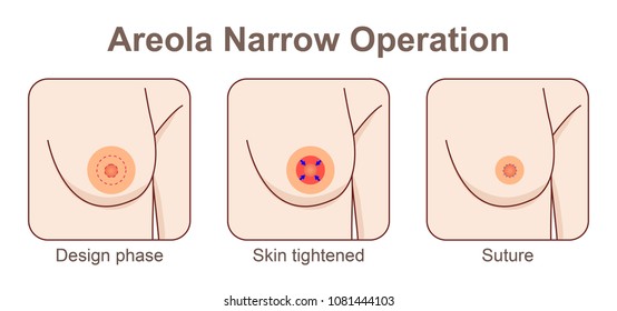 Areola Narrow Operation