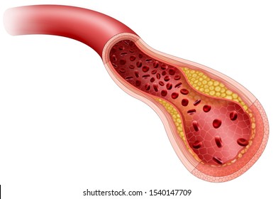 Arterial obstruction, caused by the excessive accumulation of cholesterol and fats in the walls.
