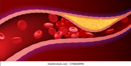 Arteries That Are Clogged With Fat That Causes Blood Clots Are A Leading Cause Of Death.