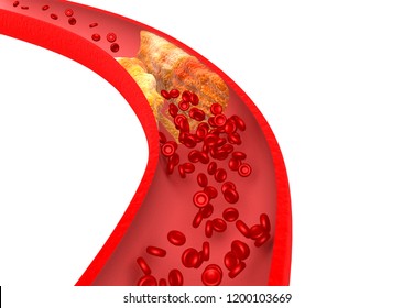 Artery blocked with bad cholesterol. clogged arteries, coronary artery plaque. 3d illustration		