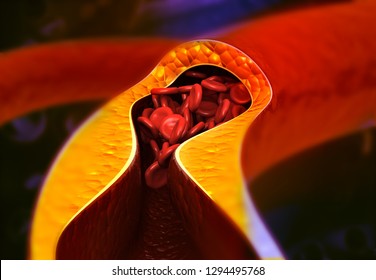 Artery Blocked With Bad Cholesterol. Clogged Arteries  Coronary Artery Plaque. 3d Render	