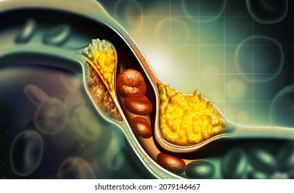 Artery Blocked With Bad Cholesterol.3d Illustration