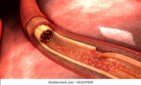 Artery Dissection 3d illustration