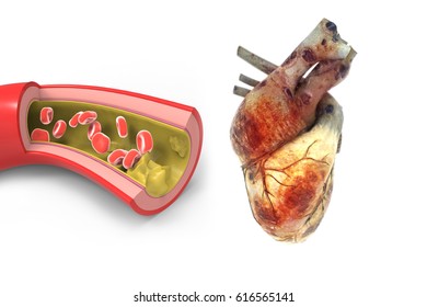 Artery With Fatty Deposits And Ill Heart,isolated On White, 3d Rendering