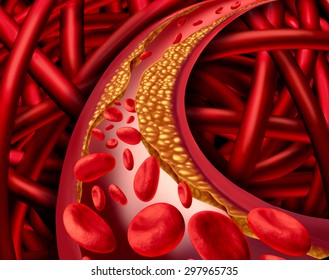 Artery problem with clogged arteries and atherosclerosis disease medical concept with a human cardiovascular system with blood cells with plaque buildup of cholesterol symbol of vascular illness.