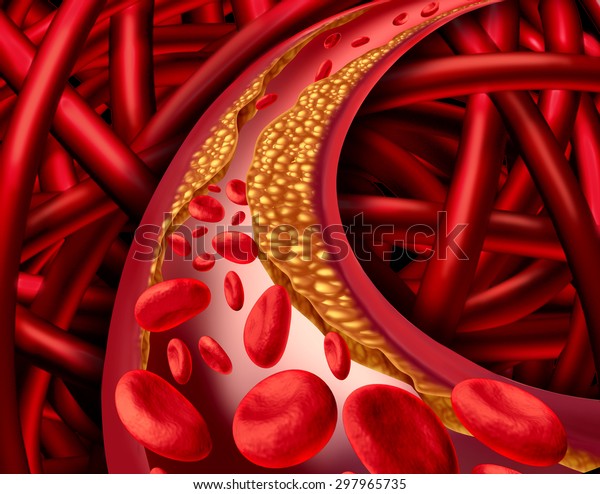 血管疾患のコレステロールのシンボルが増えたプラークを持つ血球を持つヒトの心臓血管系を持つ 動脈の詰まった動脈とアテローム性動脈硬化 症の医学コンセプトに関する動脈の問題 のイラスト素材