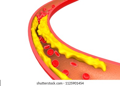 Artery section with cholesterol buildup. 3d render		