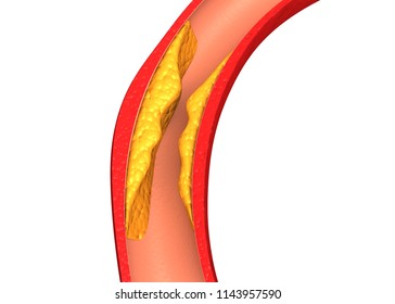 Artery section with cholesterol buildup. 3d render	