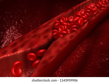 Artery section with cholesterol buildup. 3d render	