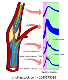Artery stenosis has the markedly changes of flow pattern. We can detected it with Doppler ultrasound. The thickening of wavefrom, and the greater velocity are the major changes that have to be noticed