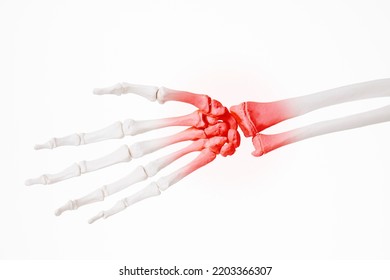 Arthritis Of Hand Joints, Rheumatoid Nodules, 3d Illustration