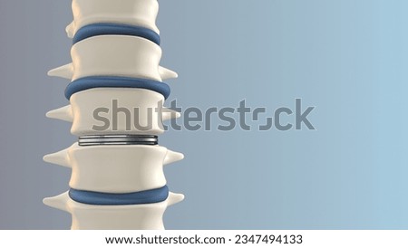 Artificial Disk replacement in the lumbar spine 3D illustration