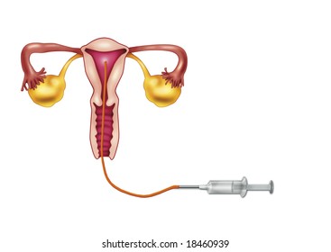 Artificial Insemination