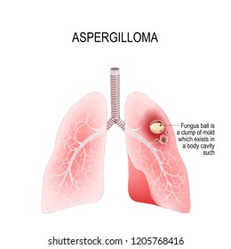 Aspergilloma Is A Clump Of Mold Which Exists In A Body Cavity. Mycetoma. Lungs Of Human With A Fungus Ball. Illustration For Medical Use