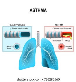 Asthma is a chronic inflammatory disease of the airways that is characterized by narrowing of the airways bronchospasm and coughing. Humans lungs and bronchi