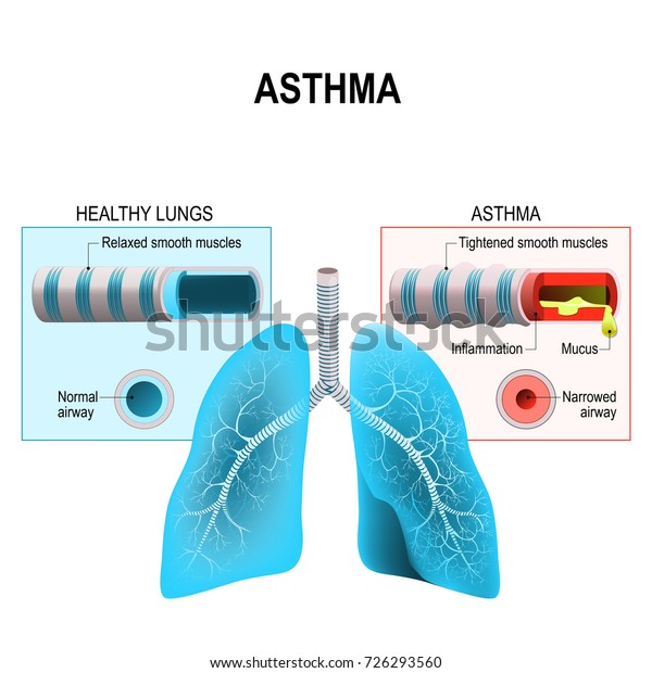 喘息は気道の慢性炎症性疾患で 気道気管支攣縮と咳の狭窄を特徴とする 人間の肺と気管支 のイラスト素材