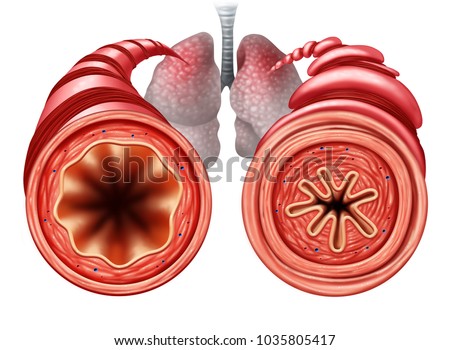 Asthma diagram as a healthy and unhealthy bronchial tube with a constricted breathing  problem caused by respiratory muscle tightening with 3D illustration elements. Foto d'archivio © 