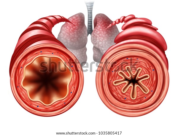 喘息図は 呼吸筋が3dイラストエレメントで締め付けられることによって引き起こされる 呼吸の困難がある健康で不健康な気管支管としての図です のイラスト素材