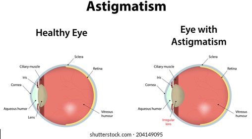 Astigmatism