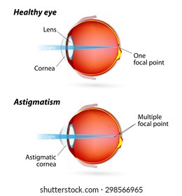 Astigmatism. Eye Disease