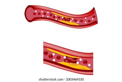 Atheroma, The Function Of Blood Clots