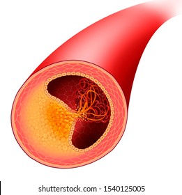Atherosclerosis arterial disease, accumulation of cholesterol and fats in the walls, with rupture of the atheroma plaque. schematic and descriptive illustration.