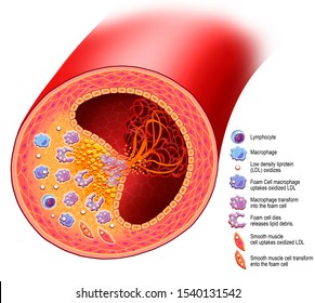 Atherosclerosis, arterial disease, with accumulation of cholesterol and fats in the walls, with rupture of the atheroma plaque. descriptive illustration.