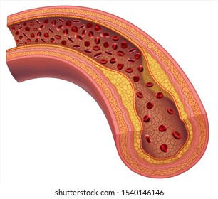Atherosclerosis, arterial disease, caused by the excessive accumulation of cholesterol and fats in the walls.
