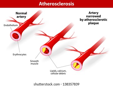 Atherosclerosis. Arteries are narrowed when fatty deposits called plaques build up inside. Atherosclerosis reduce the blood supply to vital organs such as the heart, brain and intestines.