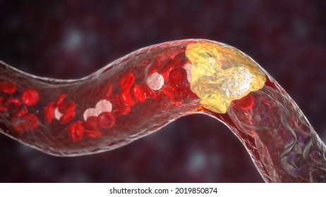 Atherosclerosis, atheromatous plaque inside artery leading to narrowing of blood vessel. 3D illustration. coronary artery disease, stroke, peripheral artery disease