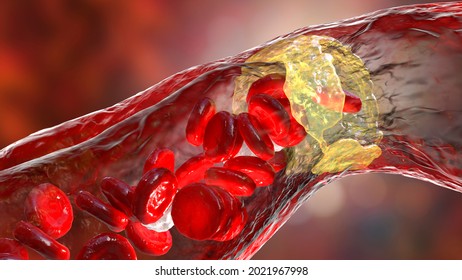 Atherosclerosis, atheromatous plaque inside artery leading to narrowing of blood vessel. 3D illustration. coronary artery disease, stroke, peripheral artery disease