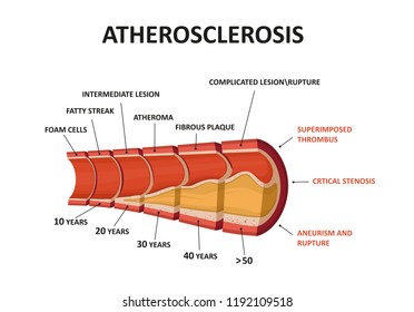 Atherosclerosis. Cholesterol in artery