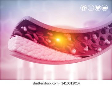 Atherosclerosis, Cholesterol plaque in artery. 3d illustration	