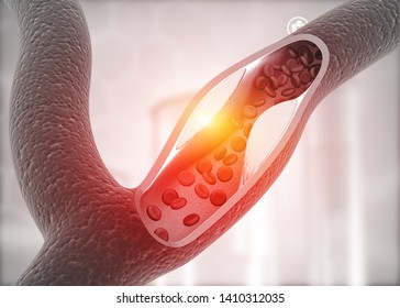Atherosclerosis, Cholesterol plaque in artery. 3d illustration