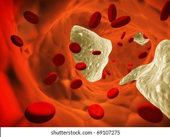 Atherosclerosis - Clogged Artery And Erythrocytes