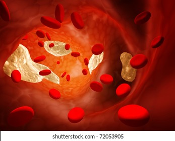 Atherosclerosis - Clogged Artery And Erythrocytes