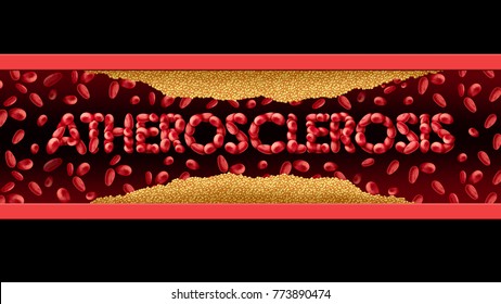 atherosclerosis coronary disease with plaque build up in the arteries medical cardiology concept with 3D illustration elements.