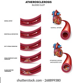 Atherosclerosis. Detailed Illustration Of Atherosclerosis Stages, Normal Heart And Damaged Heart Muscle As A Result Of The Blood Clot.