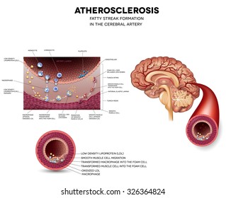 Atherosclerosis Stable Plaque Formation Cerebral Artery Stock Vector ...