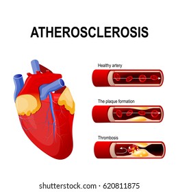 10,049 Atherosclerosis Images, Stock Photos & Vectors | Shutterstock