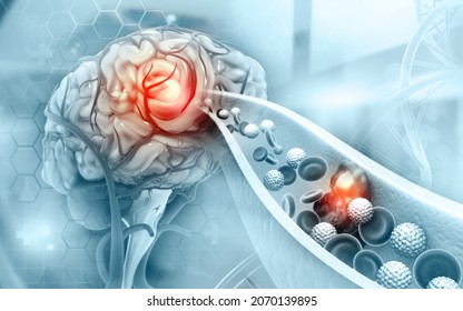 Atherosclerosis Stroke. A blood clot in the vessels of the human brain. 3d illustration
