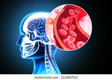 Atherosclerosis Stroke. A blood clot in the vessels of the human brain. 3d illustration