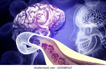 Atherosclerosis Stroke. A Blood Clot In The Vessels Of The Human Brain. 3d Illustration